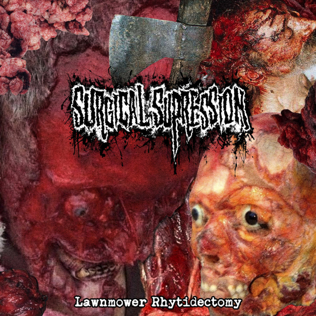 SURGICAL SUPRESSION - LAWNMOVER RHYTIDECTOMY?cache=20260915221629